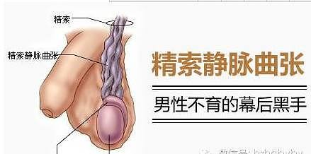 男人患上精索静脉曲张有哪些危害