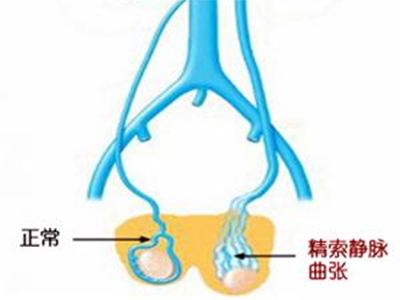 男人精索静脉曲张早期症状有什么