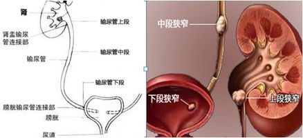 输尿管结石怎么治愈