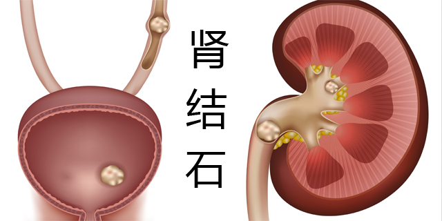 了解男性肾结石的前征兆，杜绝疾病来袭