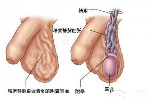 精索静脉曲张的病因是什么,不孕不育,中山健民男科